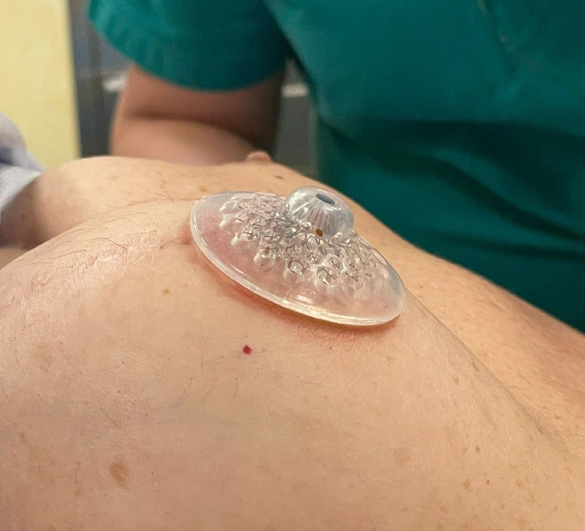 nipple-implant nipple-implant